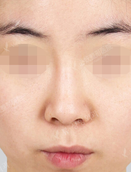 Revisional Rhinoplasty (11 Months) — Before