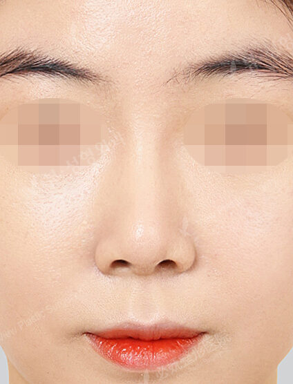 Revisional Rhinoplasty (11 Months) — After