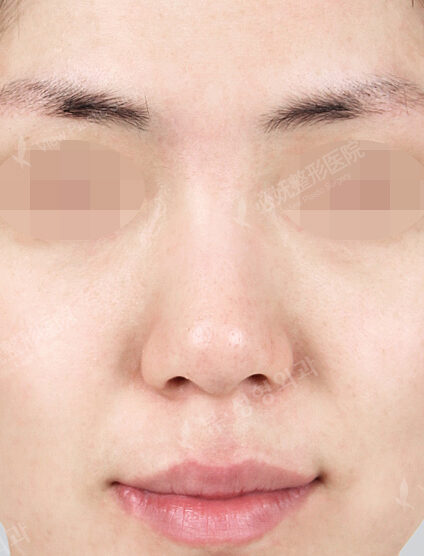 Hump Nose(5 Months) — Before