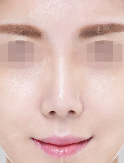 Hump Nose(5 Months) — After
