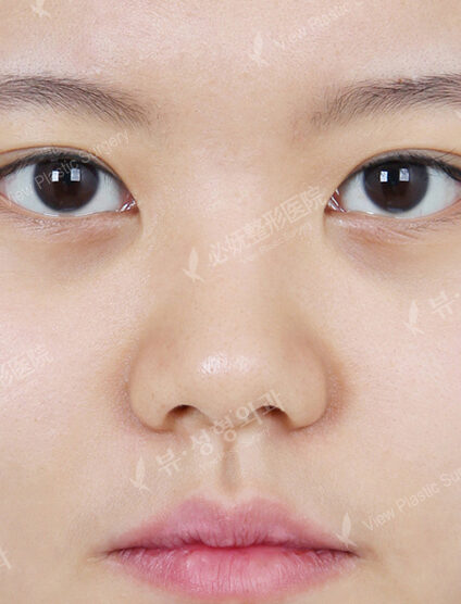 Bulbous Nose (3 Months ) — Before