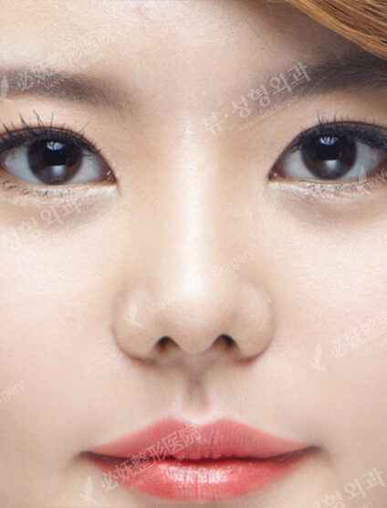 Bulbous Nose (3 Months ) — After