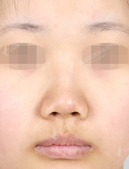 Rhinoplasty (3 Months) — Before