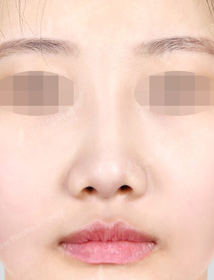 Rhinoplasty (3 Months) — After