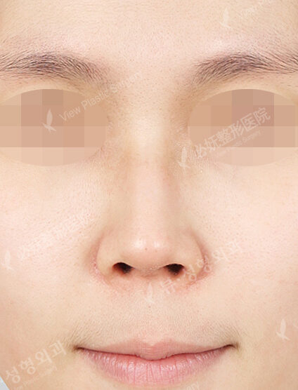 Hump Nose(3 Months) — Before