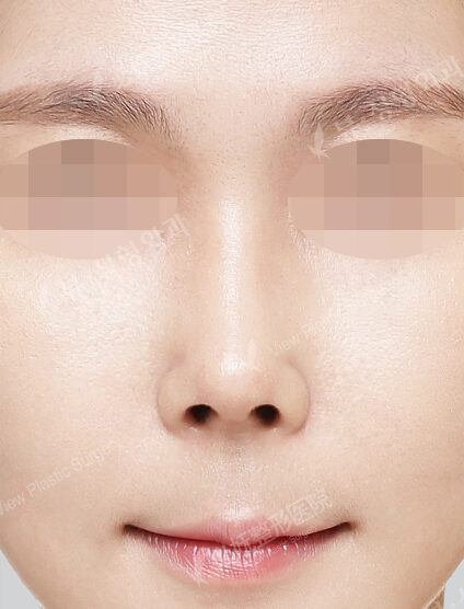 Hump Nose(3 Months) — After