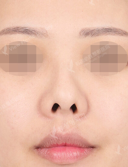 Doll Line (Vline)+ Zygoma Reduction+Revisional Rhinoplasty (3 Months) — Before
