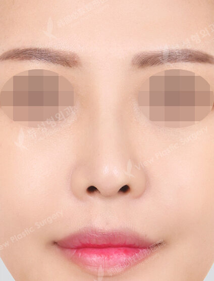 Doll Line (Vline)+ Zygoma Reduction+Revisional Rhinoplasty (3 Months) — After