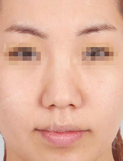 Hump Nose +Bulbous Nose+Fat Graft (Forehead Frontal Cheeks Nasolabial Front Chin)(3 Months) — Before