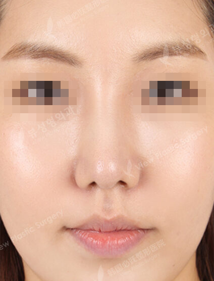 Hump Nose +Bulbous Nose+Fat Graft (Forehead Frontal Cheeks Nasolabial Front Chin)(3 Months) — After