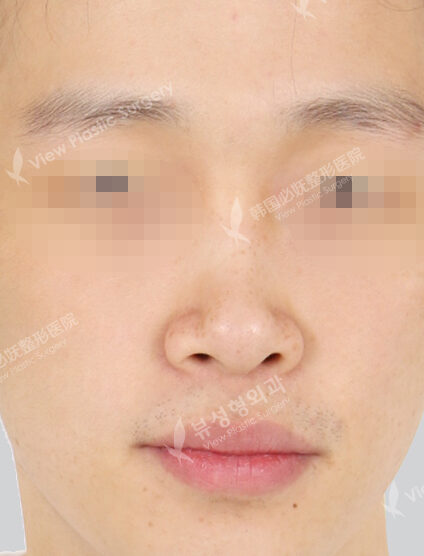 Hump Nose(3 Months) — Before