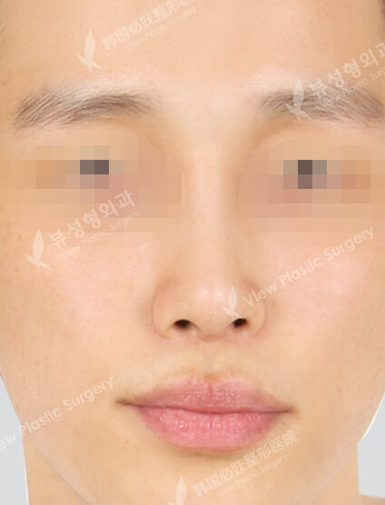 Hump Nose(3 Months) — After