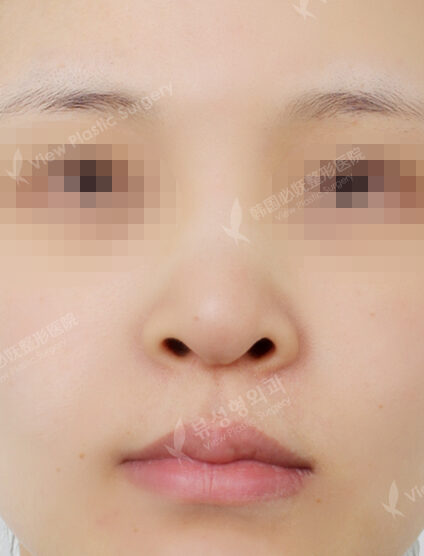 Rhinoplasty (3 Months) — Before