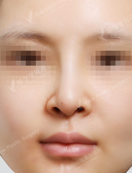 Rhinoplasty (3 Months) — After