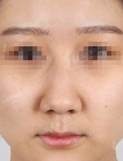 Hump Nose(3 Months) — Before