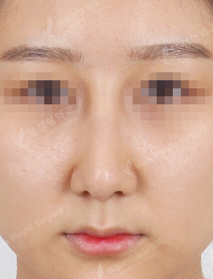 Hump Nose(3 Months) — After