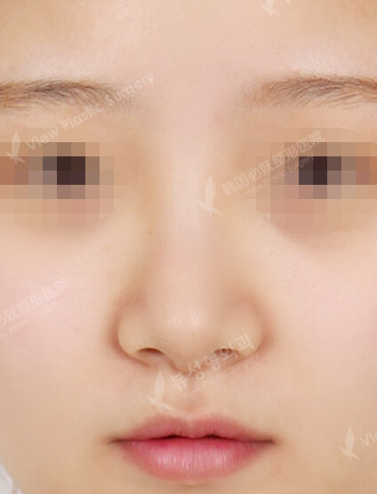 Revisional Rhinoplasty (3 Months) — Before