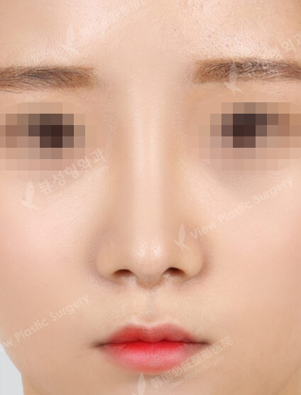 Revisional Rhinoplasty (3 Months) — After