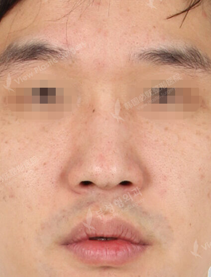 Hump Nose(3 Months) — Before