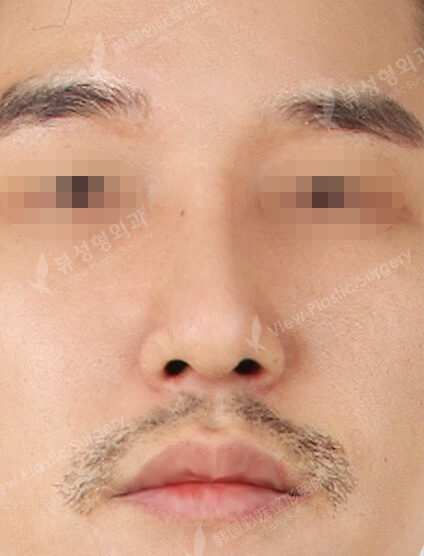 Hump Nose(3 Months) — After