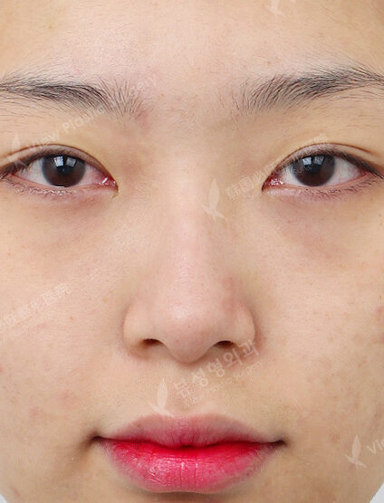 Hump Nose(3 Months) — Before