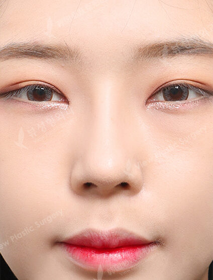 Hump Nose(3 Months) — After