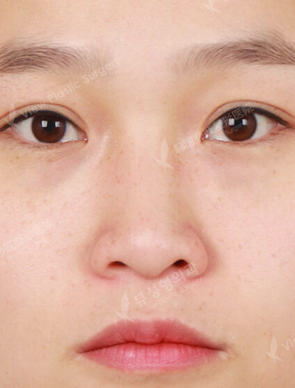 Hump Nose(3 Months) — Before