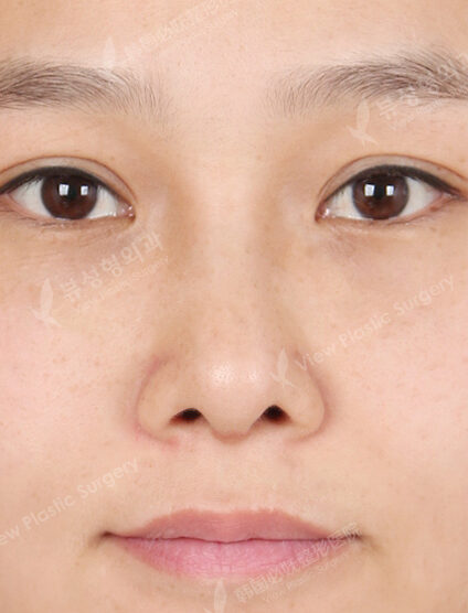 Hump Nose(3 Months) — After