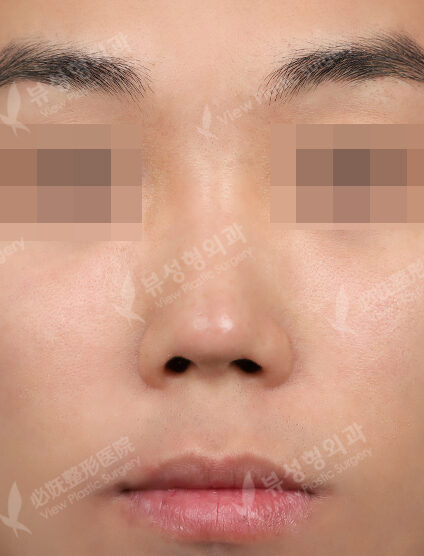 Rhinoplasty (3 Months) — Before