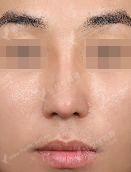 Rhinoplasty (3 Months) — After