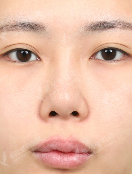 Revisional Rhinoplasty (3 Months) — Before
