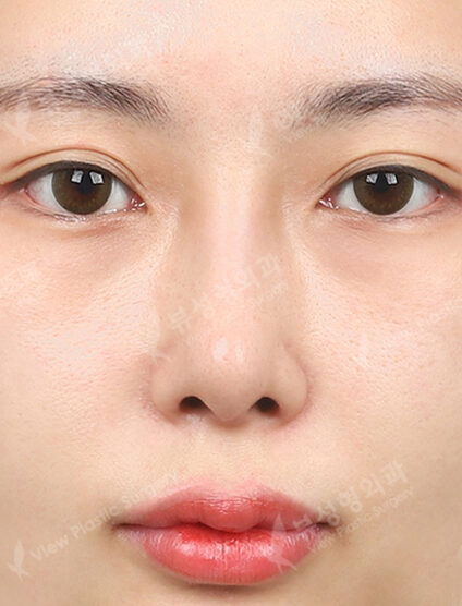Revisional Rhinoplasty (3 Months) — After