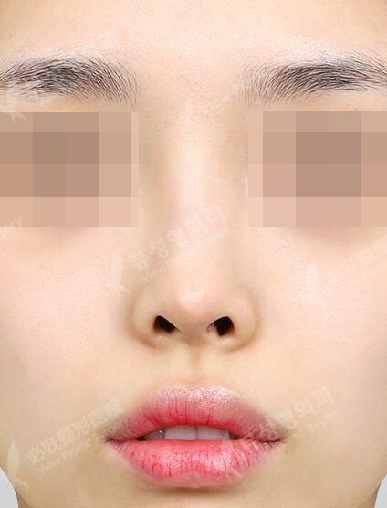 Revisional Rhinoplasty (7 Months) — Before