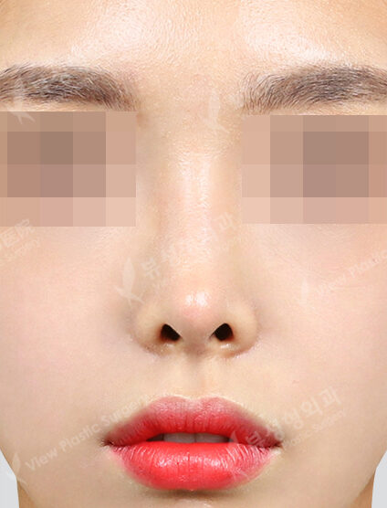 Revisional Rhinoplasty (7 Months) — After
