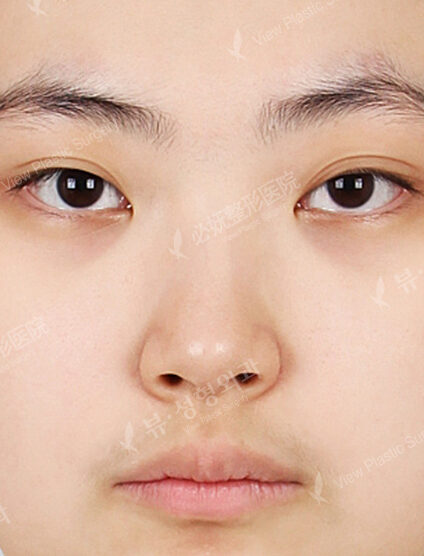 Rhinoplasty(2 Months) — Before