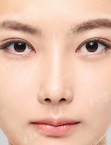 Rhinoplasty(2 Months) — After