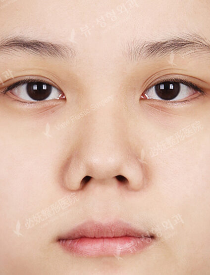 Short Nose (2 Months) — Before