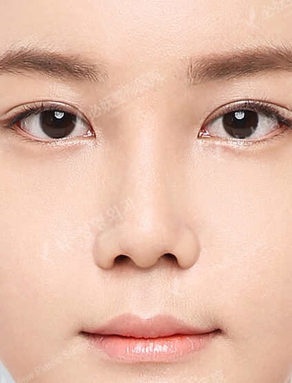 Short Nose (2 Months) — After