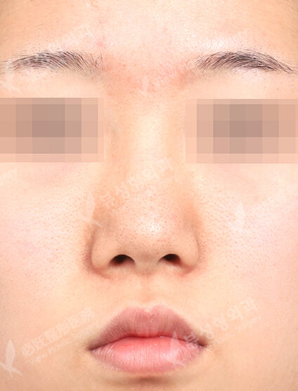 Low Nose (3 Months) — Before