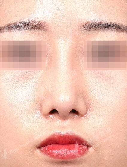 Low Nose (3 Months) — After