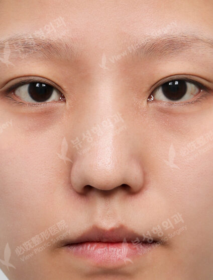 Low Nose (14 Months) — Before