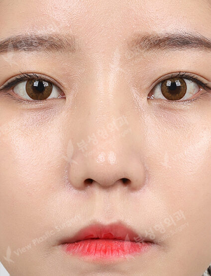 Low Nose (14 Months) — After