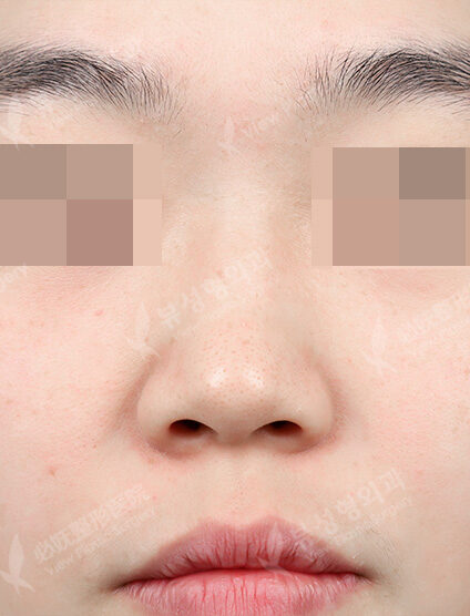 Rhinoplasty (3 Months) — Before