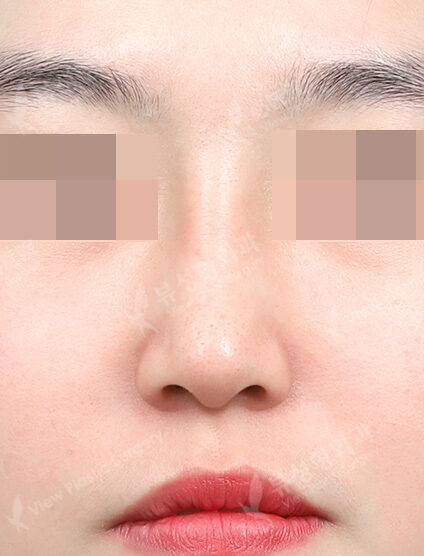 Rhinoplasty (3 Months) — After