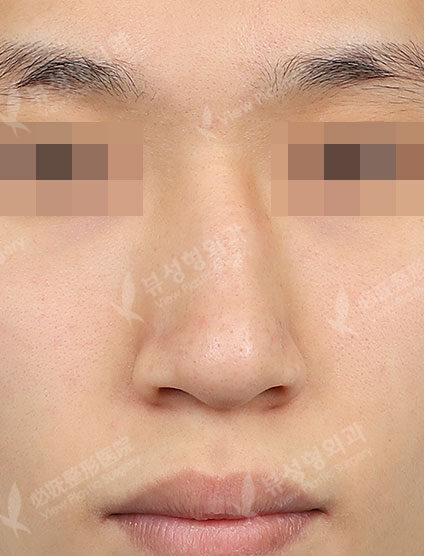 Deviated NoseBraces (3 Months) — Before