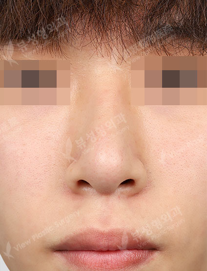Deviated NoseBraces (3 Months) — After