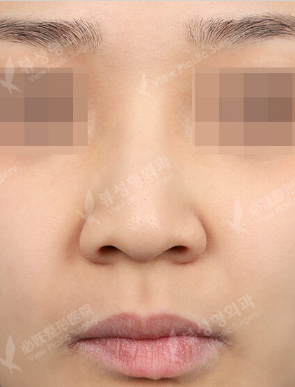 Hump Nose(3 Months) — Before