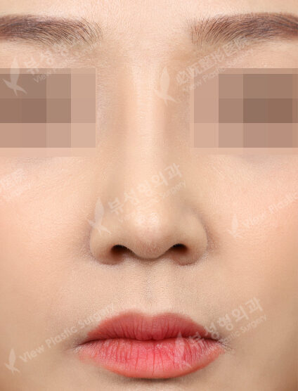Hump Nose(3 Months) — After