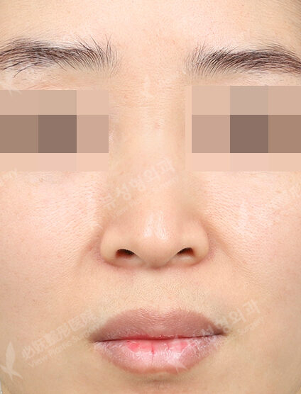 Hump Nose(3 Months) — Before