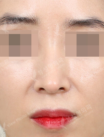 Hump Nose(3 Months) — After